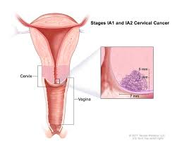 If you have an abnormal pap test or positive. Cancerhelp Online Nci Cancer Diagnosis And Treatment