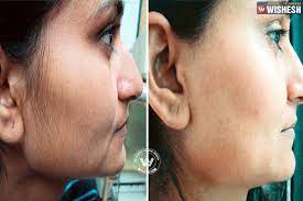 It is suitable for sensitive skin as it does not contain chemicals. Use Lemon And Sugar To Remove The Unwanted Hair Beauty Tips