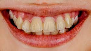 How to get rid of white spots on teeth. Causes Of Post Braces Stains On Teeth How To Remove Them