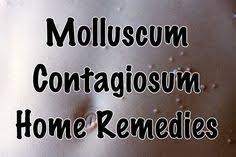 Molluscum Contagiosum Home Remedies Healthy Focus Home Remedies Remedies Natural Home Remedies