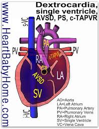 Heart Defect Cardiac Total Anomalous Pulmonary Vein Return Atrioventricular Septal Defect Pulmon Congenital Heart Defect Heart Defect Congenital Heart