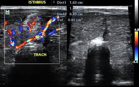 Image result for Multinodular Goiter