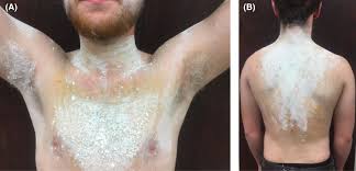 Image result for Anhidrosis