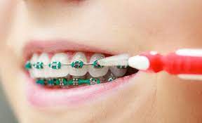 Retainer (behel lepasan) adalah sebuah alat ortodonti yang dapat dilepas dan dipasang sendiri oleh pasien, yang berguna untuk menahan gigi pada posisinya yang sudah benar. Ragam Kawat Gigi Audy Dental