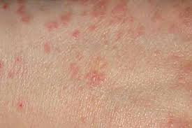 Image result for scabies human bites