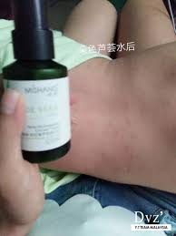 玫瑰 来自代理宝宝的反馈儿子皮肤不好这是年前的时候湿疹留下的疤前几天想起来给他用芦荟水喷不到一个星期就好的差不多了