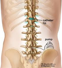 Image result for Intrathecal Pump