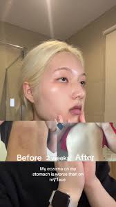 Moisturising Exzema Creams