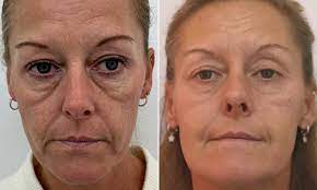For some people, results of surgery may last a lifetime. Women Are Raving About 400 Non Invasive Skin Lifting And Tightening Treatment That Erases Bags Daily Mail Online