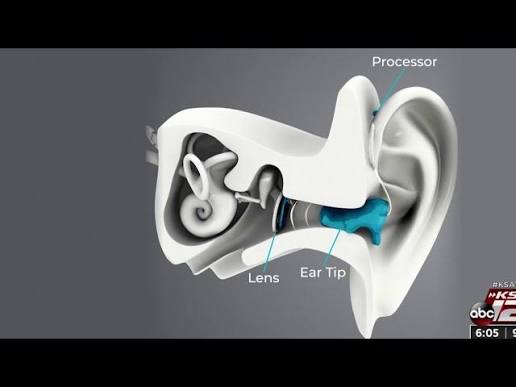 New device for hearing loss acts like a contact lens for the ear - YouTube