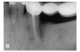 Jun 25, 2015 · metal ii. Scielo Brasil Cemental Tear A Case Report With Nonsurgical Periodontal Therapy Cemental Tear A Case Report With Nonsurgical Periodontal Therapy