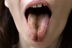 Image result for black hairy tongue symptoms
