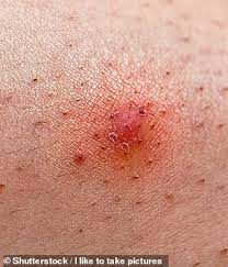 Often, an ingrown hair will go away on its own. This Cult Favourite Solution Prevents Ingrown Hairs And Razor Bumps Daily Mail Online