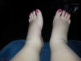 Intepaturile de insecte sunt in general benigne dar, in unele cazuri, intepaturile de viespe sau albine pot sa provoace reactii alergice grave. Intepaturi De Insecte Tot Ce Trebuie Sa Stii De La Prevenire La Tratament Si Urgente 1 Paduchi