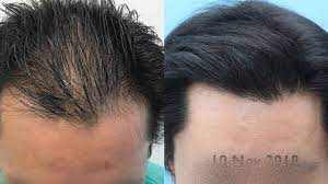 Precauzioni e cure · non bere alcolici per 5 giorni · ridurre quanto più possibile la sudorazione · evitare di urtare e . Caso N 12 Trapianto Fue A Capelli Non Rasati A 8 Mesi Insalaco Clinic