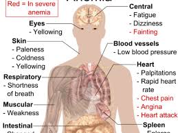 Image result for Anemia simii