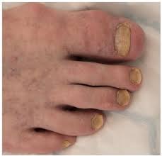 Image result for Yellow nail syndrome feet