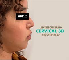 LIPOESCULTURA CERVICAL 3 D A lipoaspiração cervical é um procedimento para  remoção de gordura sub-mentoniana (papada) indesejada, conferindo  jovialidade, bem-estar emocional e por consequência eleva a autoestima.  Lembrando que as características faciais