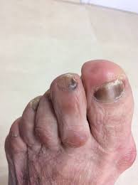 Manchas Negras En Las Unas De Tus Pies Therapies Salud Pies Y Terapia En Sevilla