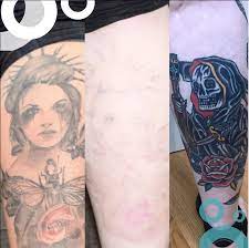 These laser tattoo removal techniques are easy and with very minimal side effects.black inked tattoos can be removed easily by breaking down the pigment colors using a high intensity laser beam.other colors can be removed by using other lasers according to the pigment colors. When Can You Tattoo Over Laser Tattoo Removal Removery