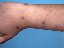 Image result for scabies bite