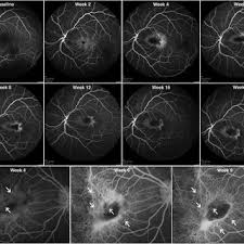 Check spelling or type a new query. Pdf Primate Model Of Chronic Retinal Neovascularization And Vascular Leakage