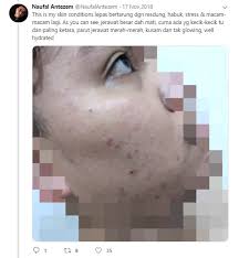 Cara menghilangkan bekas jerawat hitam di pipi tentu sudah sering dilakukan oleh banyak orang. Cara Menghilangkan Parut Jerawat