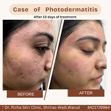 Image result for Photodermatitis
