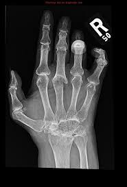 Rheumatoid arthritis is an immune system condition, or autoimmune disorder, that causes inflammation of the lining of the joints. Rheumatoid Arthritis Radiology Case Radiopaedia Org