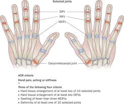 In the following article, we shall be looking at the. Hand Osteoarthritis A Heterogeneous Disorder Nature Reviews Rheumatology