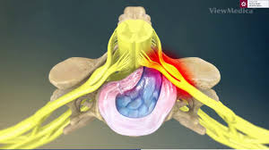 Hernia de disc apare prin prolabarea nucleului pulpos prin fisurile inelului fibros ale discului degenerat spre ligamentul longitudinal posterior astfel: Hernia De Disc Cervicala Dr Dan Martin
