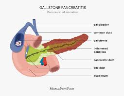 Image result for Gallstone