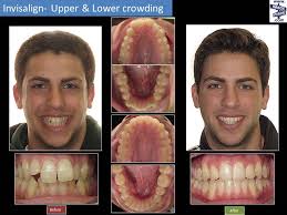 I smiled without my teeth because smiling with my teeth looked and felt awkward. Invisalign Before After Freehold Hightstown Manalapan Nj Orthodontist Brace Place Orthodontics