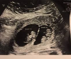 Maybe you would like to learn more about one of these? Twin Ultrasound At 17 Weeks Babycenter