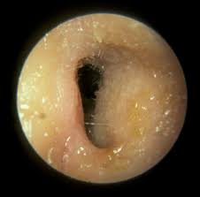 Image result for Acute Otitis Externa