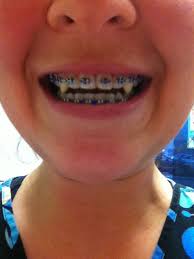 Those who want vampire teeth for the rest of their lives first must find a dentist who will shorten their front teeth and then file their canines to a point so they look longer and more pointed than the front teeth. Working At The Dentist Pays Off In More Ways Than One Custom Fit Vampire Fangs Made From Maxi Temp Crown And Bridge M Dentist Dental Hygiene Kittens Playing
