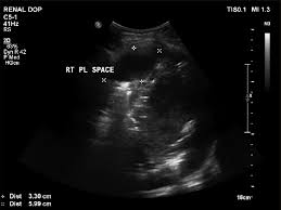 A loculated pleural effusion are most often caused by an exudative (inflammatory) effusion. Ultrasonography Showing Right Sided Loculated Pleural Effusion Download Scientific Diagram