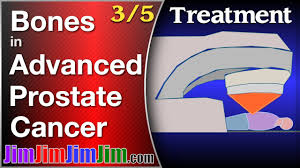 Treatment for bladder cancer depends on your overall health, progression of the c. Metastatic Prostate Cancer In The Spine Bones Youtube