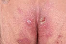 Image result for Skin Ulcer