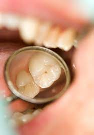 If you need a cavity filled and are delaying your appointment, make sure to take the following into consideration: If Your Dentist Can T Detect A Cavity How Can She Treat It Chicago Smile Spa