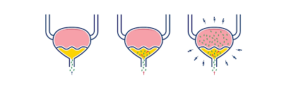 Urinary Tract Infection (UTI): Symptoms, Causes & Treatment | TENA