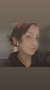 Has anyone experienced bleeding into cysts after sclero?