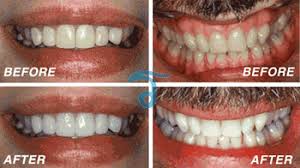 For others, it might take a few days longer to start seeing results. Affordable Laser Teeth Whitening In Thailand 1 Hour Tooth Color Restoration