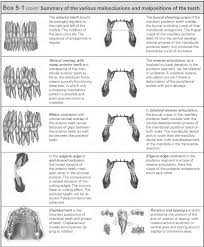 Malposition Of Teeth In The Frontal Plane Dental Technology How To Tips