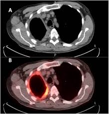 The thickened visceral pleural peel may be visible on ct (figure 9). State Of The Art Radiological Investigation Of Pleural Disease Respiratory Medicine