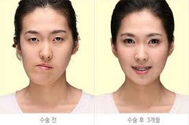 23 Most Extreme South Korean Plastic Surgery Before After Photos 6 Korean Plastic Surgery Cosmetic Surgery Plastic Surgery