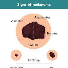 Skin cancer screening schedule if you have developed new moles, or a close relative has a history of melanoma, you should examine your body once a month. Abcde Of Skin Cancer Cone Health