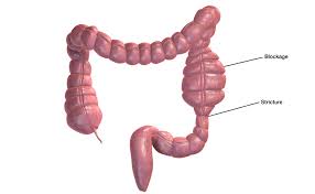 Talk to your doctor about a colonoscopy is a common outpatient procedure that examines the inside of your large intestine. Intestinal Strictures In Crohn S Disease Ibdrelief
