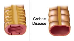 Crohn disease, also known as regional enteritis, is an idiopathic inflammatory bowel disease characterized by widespread discontinuous gastrointestinal tract inflammation. 5 Early Warning Signs Of Crohn S Disease