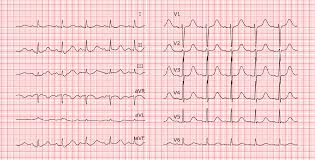 Veranderungen Des Qt Intervalls Ecg
